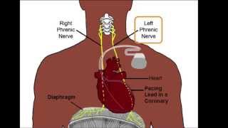 Left Phrenic Nerve Anatomy Relative to the Coronary Venous System [upl. by Lebezej632]