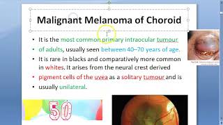 Ophthalmology Malignant Melanoma Choroid [upl. by Assetal568]