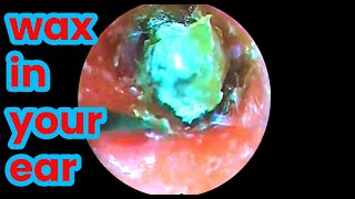 asmr ear cleaning  wax in your ear  Ear health  ear piercing cleaning how to unclog your ear [upl. by Aryamoy]