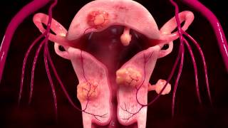 Uterine Fibroid Embolization Treatment [upl. by Llehsyar]