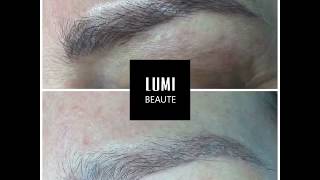 Tattoo removal laser and scar free for eyebrow microblading [upl. by Bevon]