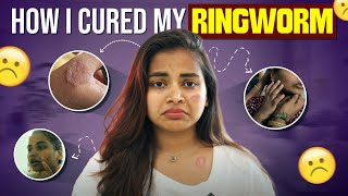 My severe skin allergy update Ringworm வந்தா இத பண்ணுங்க  Keerthi Shrathah [upl. by Latoyia296]