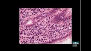 Nodular Gastritis [upl. by Colpin851]