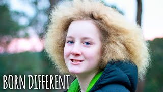 I Have Uncombable Hair Syndrome  BORN DIFFERENT [upl. by Direj]