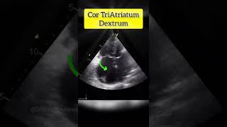 Cor Triatriatum Dextrum echocardiography cardiology Echocardiography test [upl. by Fredela]