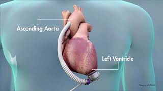 Treating Heart Failure with the Heartmate 3 LVAD [upl. by Ilaw]