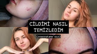 SİVİLCELERİMDEN NASIL KURTULDUM ✨ roaccutane’sız [upl. by Enidlareg]