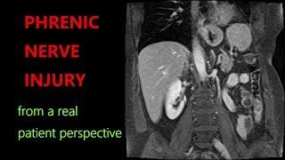 PHRENIC NERVE INJURY PARALYZED DIAPHRAGM SYMPTOMS TREATMENTS MedEd MedTwitter [upl. by Gilliette]