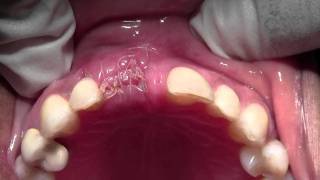 Implant Placement with Bone Grafting 8 Site Mineross amp dPTFE 1 Week postop [upl. by Sidell]