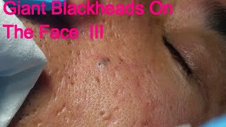 Giant Blackheads  Part III [upl. by Corissa]