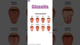 Glossitis Shortsvideo CPC Exam Medical Coding and Billing medicalcodercertified [upl. by Heyes]