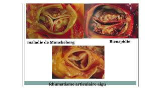 rétrécissement aortique [upl. by Trembly]