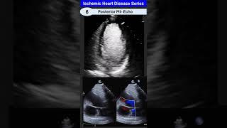 Ischemic Heart Disease 6 Posterior MI [upl. by Leuqcar790]