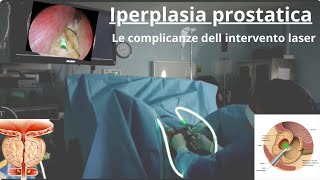 Prostata ingrossata Le complicanze dell intervento chirurgico [upl. by Hnacogn]