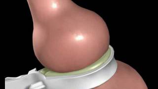 Lap Band Surgery  Laparoscopic Gastric Banding  Animation [upl. by Inesita]