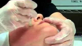 Dermapen Micro Needling Treatment [upl. by Enilegna]