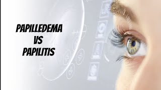 Papilledema VS Papillitis Optic neuritis [upl. by Nairdad]