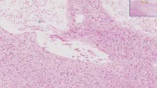 Histopathology Brain Cerebral infarct recent [upl. by Akiram465]