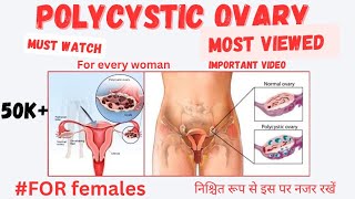 mystery of polycystic ovary पॉलीसिस्टिक अंडाशय पर वीडियोLivealife55 [upl. by Saretta587]