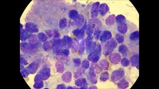 Neuroblastoma in the bone marrow [upl. by Sirrap]