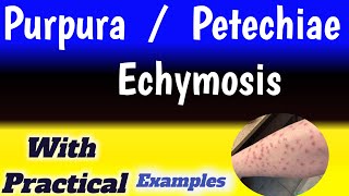 petechiae vs ecchymosis vs purpura [upl. by Obelia]