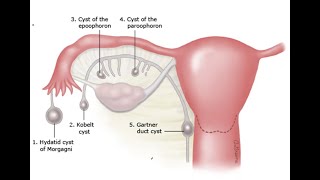 Gynecology 057 Wolffian duct remnant abnormality Gartner duct cyst Hydatid Morgagni Epoophoron [upl. by Nord528]