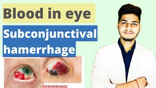 Subconjunctival Hemorrhage Treatment Causes Symptoms  आखों में लाली आना । Redness eye trearment [upl. by Whitcher512]