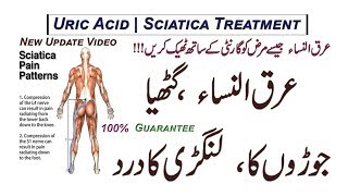 Arq Un Nisa  Gathiya  Joron  Langri Ke Dard Ka Ilaj  Uric Acid  Sciatica Treatment [upl. by Ariek273]