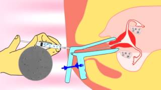 Intrauterine insemination IUI videoflv about infertility and ivf treatment [upl. by Attehcram368]