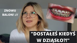 Jak wygląda przeszczep dziąsła Pokrycie recesji dziąseł [upl. by Nadya400]