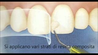 dott Montironi dentista  OTTURAZIONE ESTETICA ANTERIORE  CONSERVATIVA DENTALE [upl. by Refynnej]