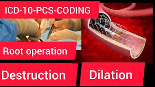 ICD10PCS codingRoot operation destruction amp dilation [upl. by Adner]