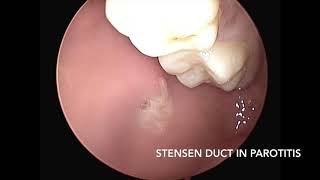 Stensen  Parotid Duct pus discharge in chronic parotitis patient [upl. by Gnex]