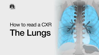 How to Read a Chest XRay The Lungs [upl. by Figone]