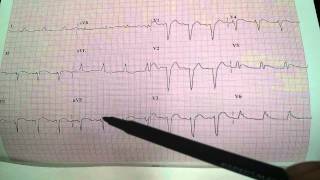 Severe Substernal Chest Pressure EKG Electrocardiogram ECG Dr Uri BenZur MD [upl. by Crow822]