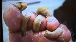 What is a fungal nail infectionMinnesota Podiatrist Explains wwwinnovativefootcarecom [upl. by Kirkpatrick]