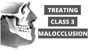 Management of Class 3 Malocclusion Orthodontics [upl. by Donica]