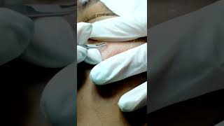 The Blackhead Extractions Breakthrough [upl. by Aihcrop400]