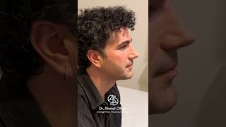 Rhinoplasty Turkey 👃🏻 Dr Ahmet Dilber rhinoplastyturkey rhinoplasty plasticsurgery nosejob [upl. by Alden]