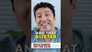 How to treat a burn blister at home Tips to avoid burn scar  Dr Pavan Murdeshwar [upl. by Inaja779]