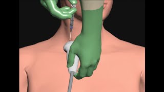 Central Line Placement by Cal Shipley MD [upl. by Angele]