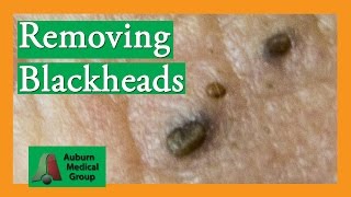 Several Blackheads  Auburn Medical Group [upl. by Rachael756]