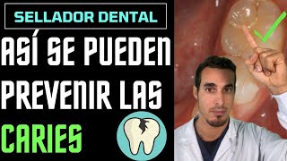 Cómo PREVENIR las CARIES en NIÑOS  SELLADORES de fosetas y FISURAS [upl. by Rickard720]