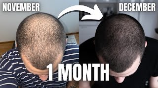 FINASTERIDE MINOXIDIL amp DERMA ROLLING 2 MONTHS INSANE RESULTS [upl. by Eerpud]