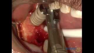 Innovative Autogenous Bone Collector Dental XP [upl. by Berg629]