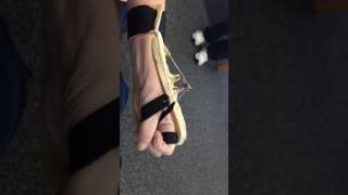 Radial Nerve Palsy splint [upl. by Bocock]