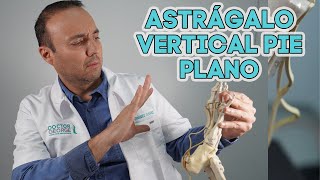 Astrágalo vertical como pie plano [upl. by Anderson538]