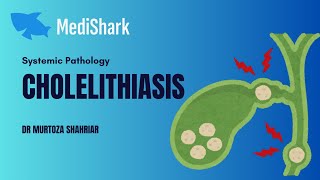 Systemic Pathology Cholelithiasis Dr Murtoza Shahriar [upl. by Eppie]