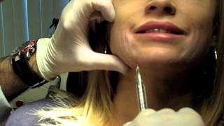 Cannula Method for Fillers  Dr Nissan Pilest Irvine CA [upl. by Myrt37]