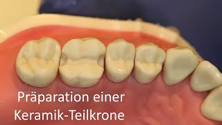 Präparation einer KeramikTeilkrone [upl. by Ringsmuth746]